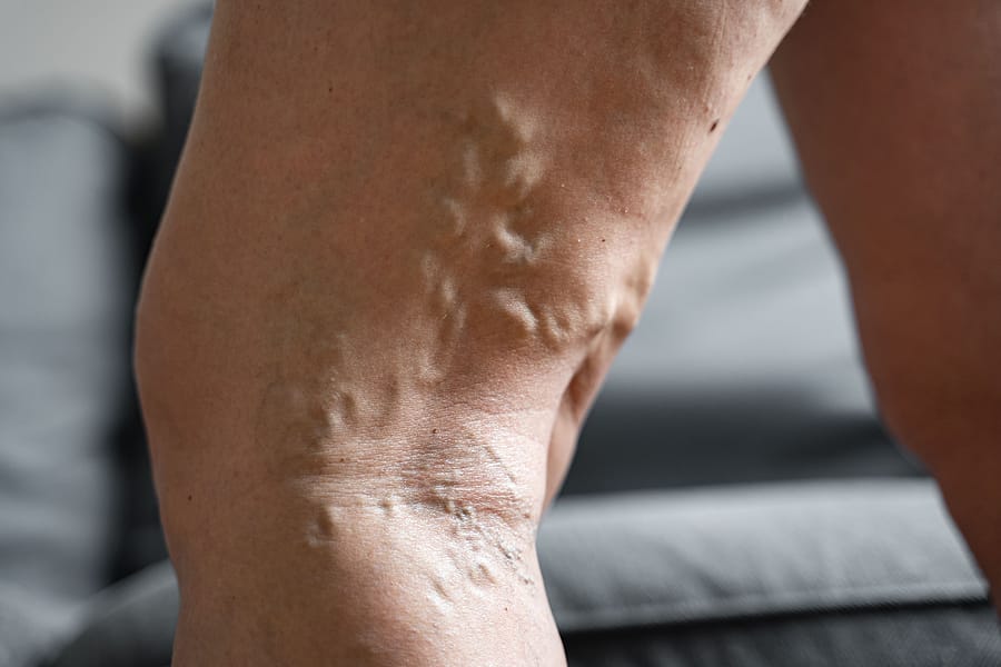 Pain Management for Varicose Vein Pain
